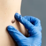 برداشتن خال در قزوین توسط شاین سنتر