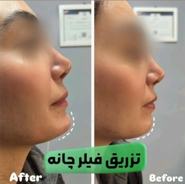 تزریق فیلر در مرکز لیزر و زیبایی شاین قزوین - شاین سنتر
