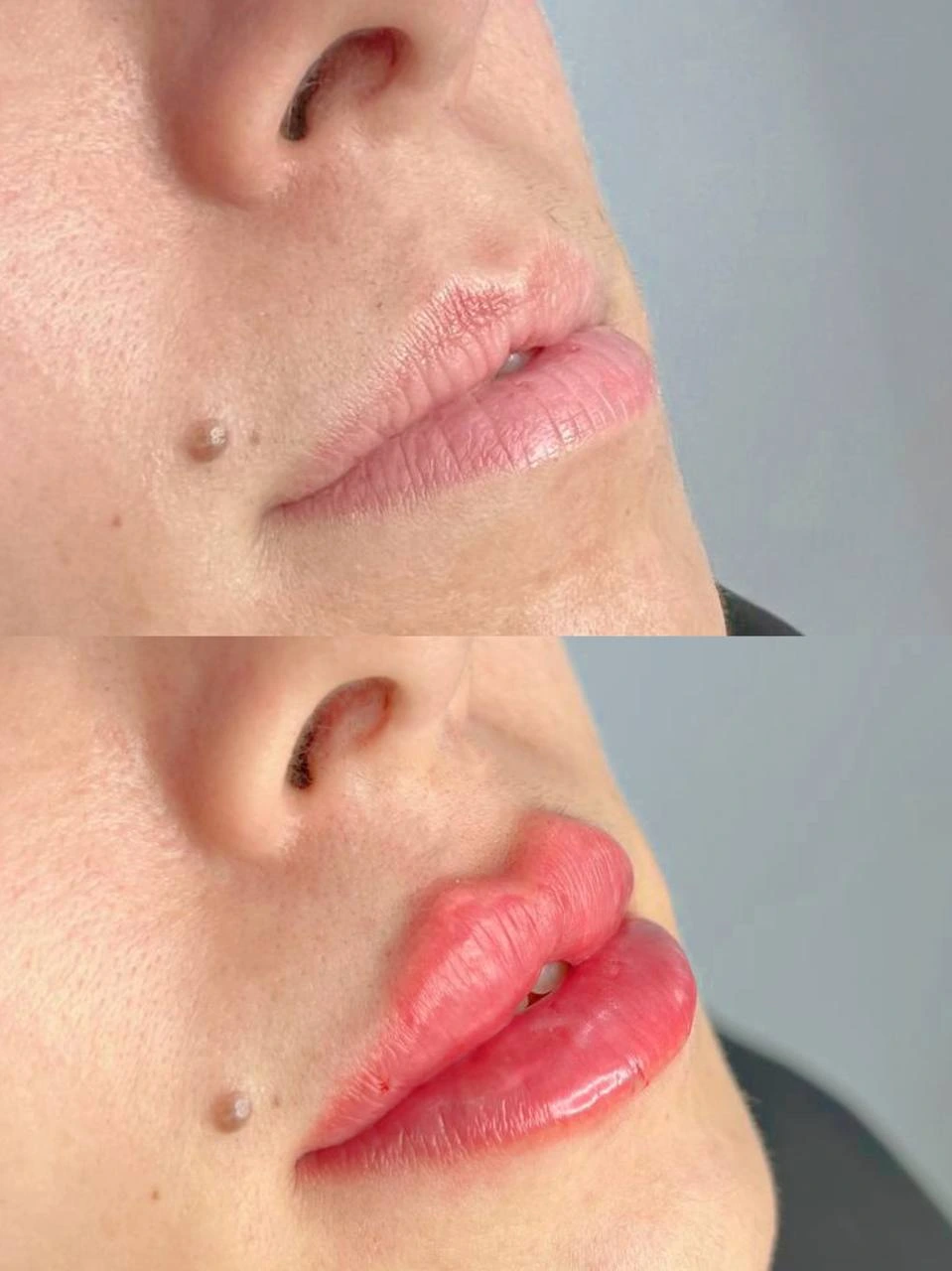 تزریق فیلر در مرکز لیزر و زیبایی شاین قزوین - شاین سنتر
