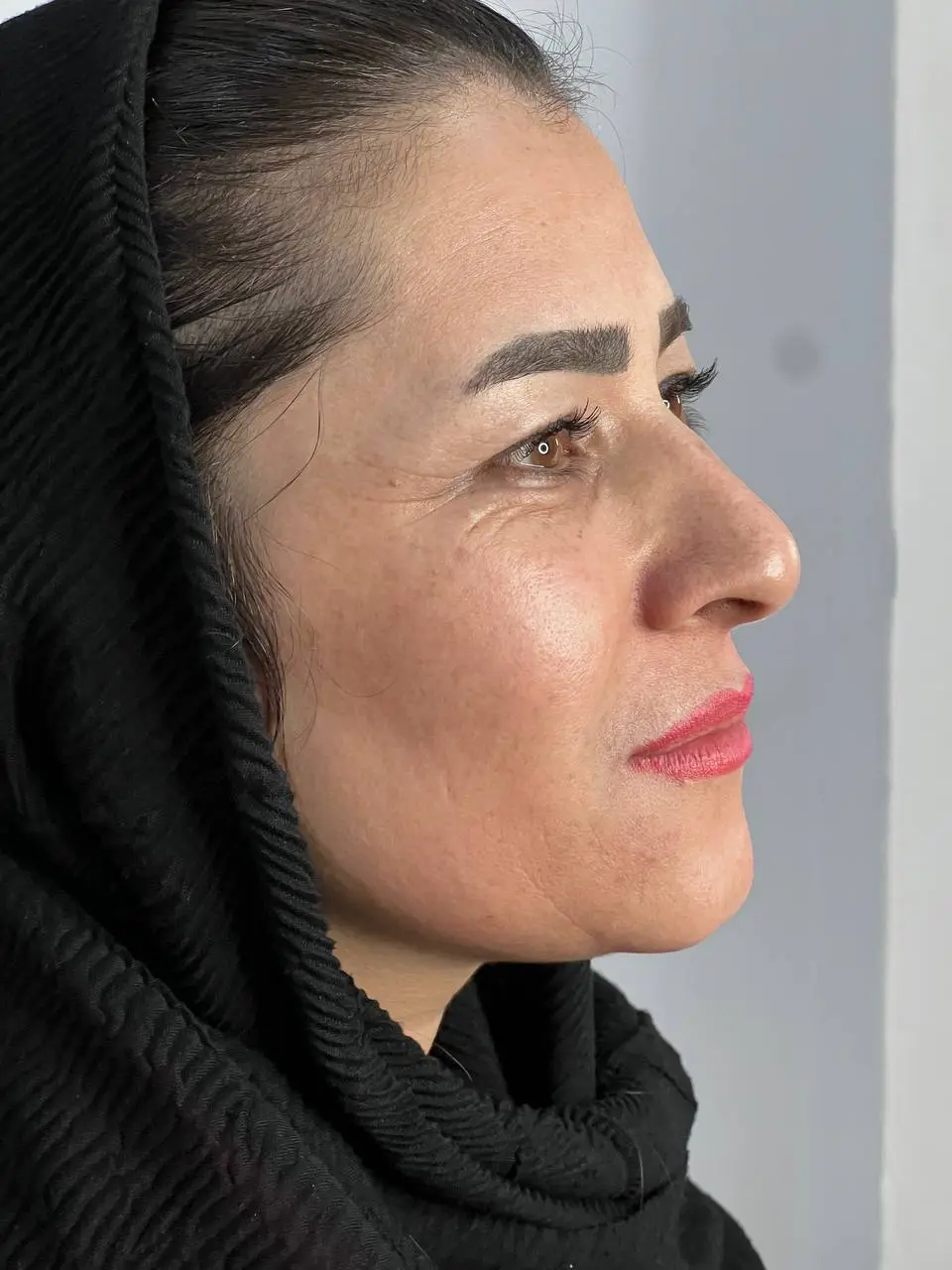 رفع لک و کک و مک با لیزر کیو سوییچ در شاین سنتر قزوین