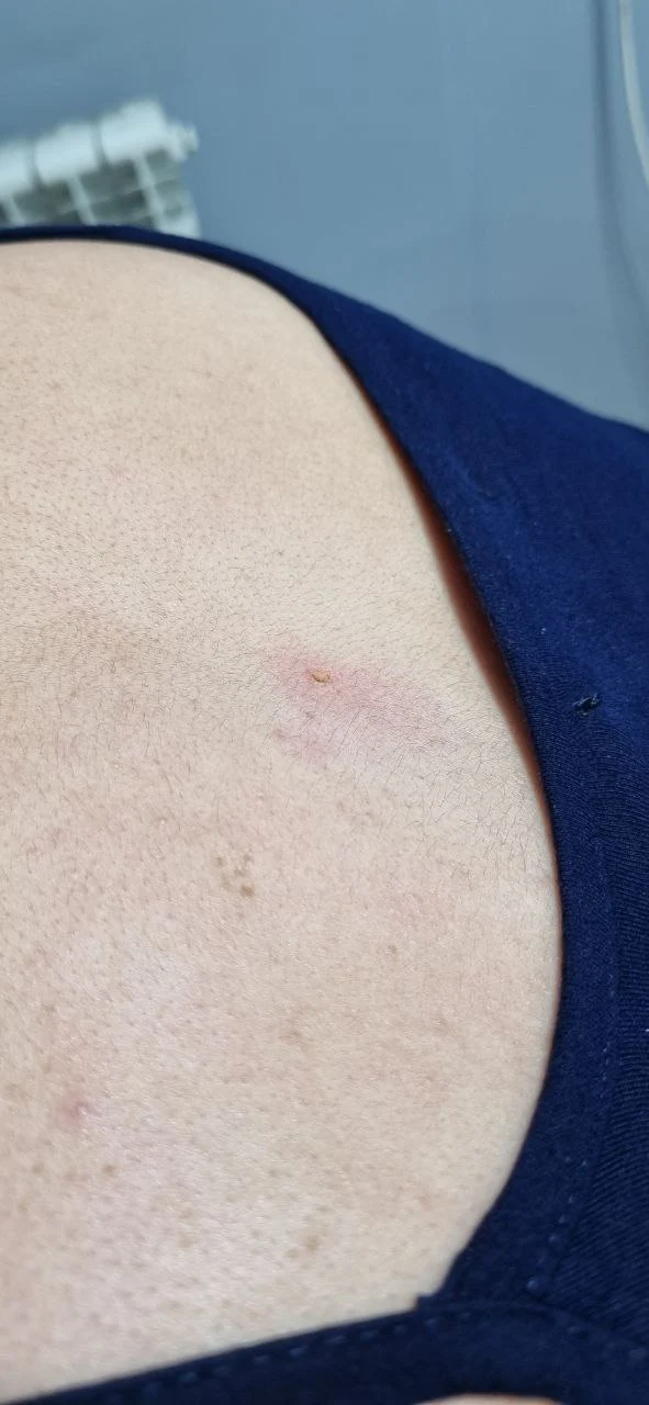 remove mole in shine center qazvin after shinecenter.ir برداشتن خال در قزوین - بعد