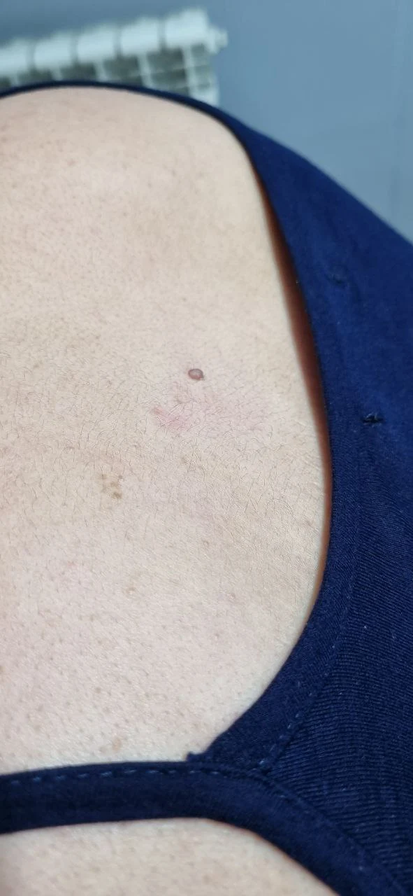 remove mole in shine center qazvin before shinecenter.ir برداشتن خال در قزوین - قبل